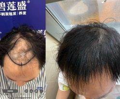 -碧莲盛·不剃发植发