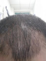 点击看大图 -大麦微针植发丨全国连锁