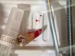 -上海仁爱医院口腔科 · 种植