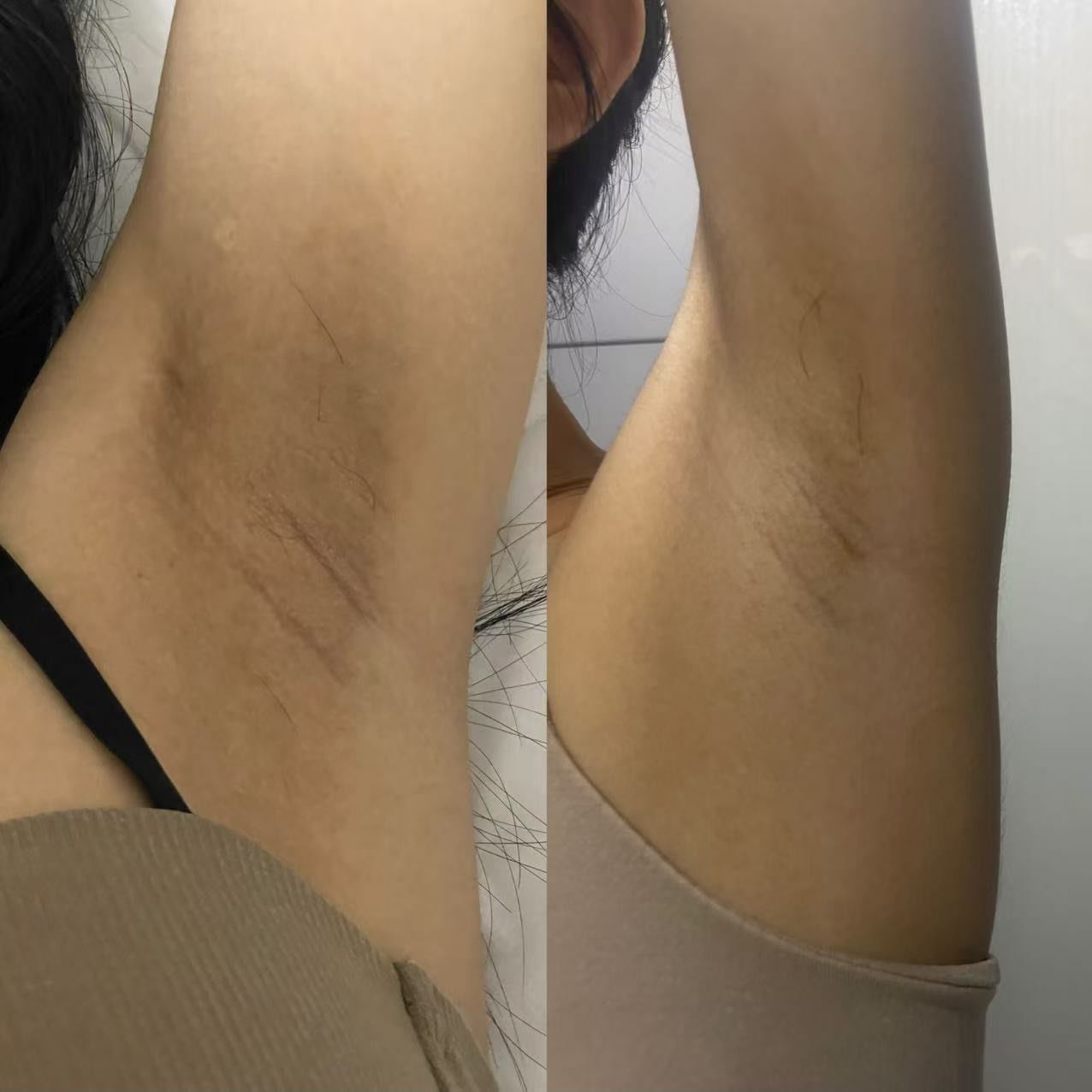 腋下对比真的白了有没有!