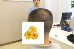 -大麦微针植发丨全国连锁