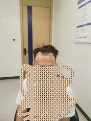 -大麦微针植发全国连锁