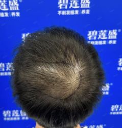 -碧莲盛·不剃发植发