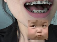 -上海仁爱医院口腔科 · 种植