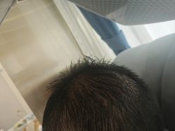-碧莲盛·不剃发植发