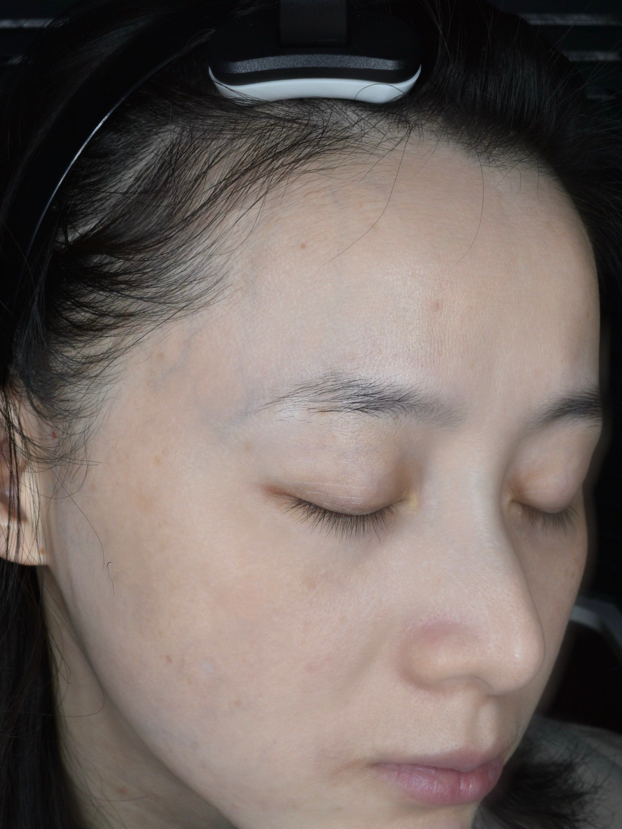 【超皮秒祛斑】体验后当天效果分享