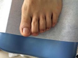 -德哥灰指甲脚气甲沟炎跖疣护理