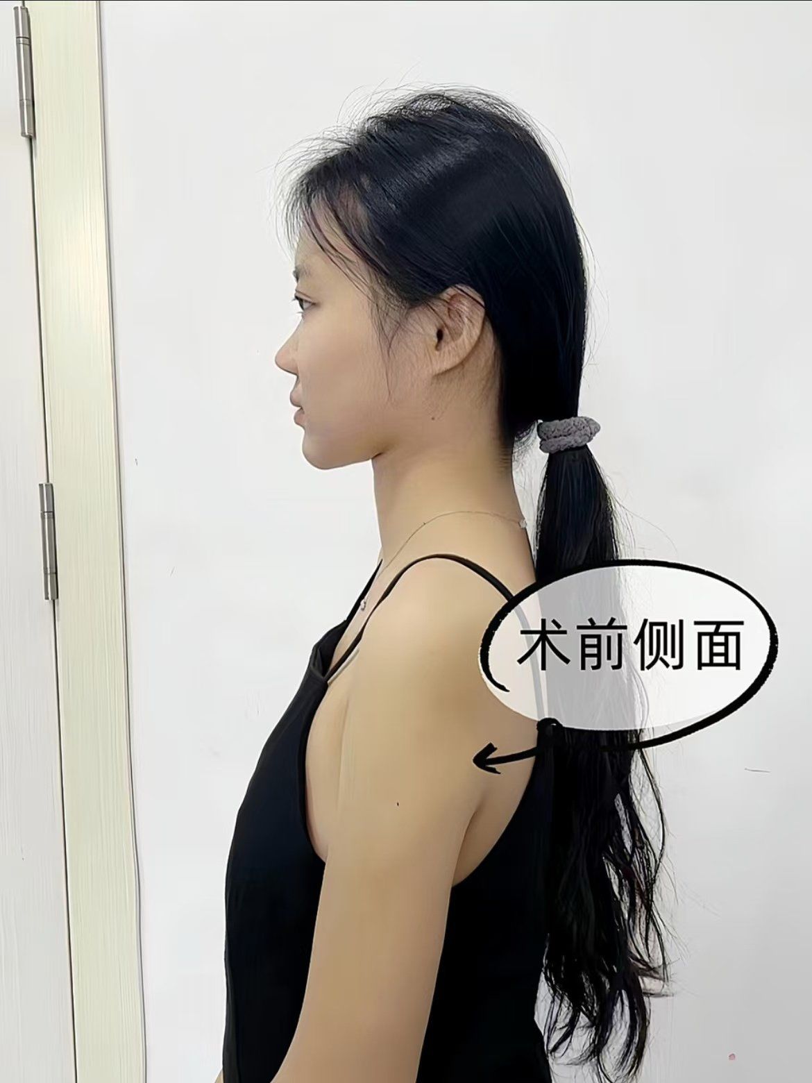 平胸🐻最大的困扰就是穿衣服不好看,撑不起来,想过做自体填充,但是