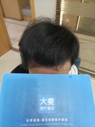 -大麦微针植发丨全国连锁