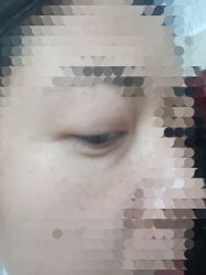 -广州健丽·去眼袋医疗美容机构