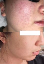 -美肤盾祛痘·问题肌头疗管理中心