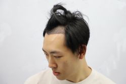 -大麦微针植发丨全国连锁