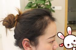 -大麦微针植发丨全国连锁