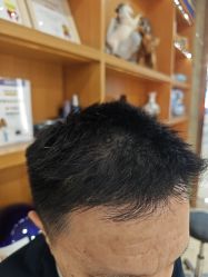 -大麦微针植发全国连锁