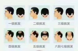 点击看大图 -大麦微针植发全国连锁