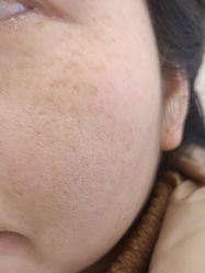 体验前-杭州米兰柏羽医疗美容医院