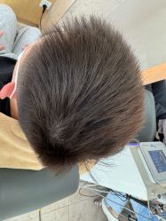 -大麦微针植发丨全国连锁