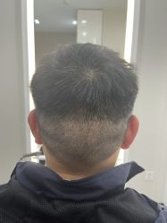 -大麦微针植发全国连锁