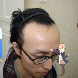 -大麦微针植发丨全国连锁