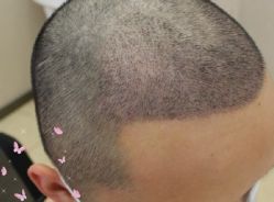 -大麦微针植发丨全国连锁