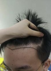 -大麦微针植发丨全国连锁