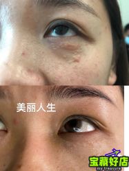 -美丽人生祛斑扁平疣汗管瘤中心