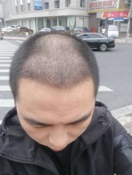 点击看大图 -大麦微针植发丨全国连锁