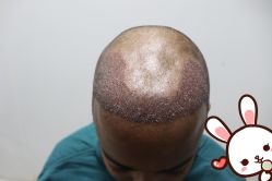 点击看大图 -大麦微针植发丨全国连锁