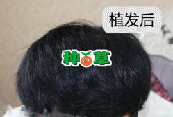 -大麦微针植发全国连锁