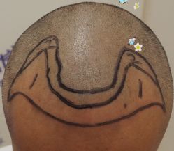 -大麦微针植发全国连锁