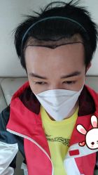 -大麦微针植发丨全国连锁