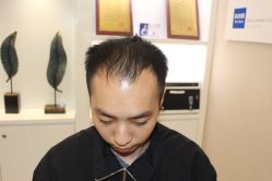 -大麦微针植发丨全国连锁