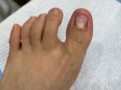 -Andrew指甲专科灰指甲·甲沟炎矫正·3D步态矫形鞋垫定制(浦三路店)