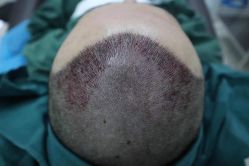 -大麦微针植发全国连锁