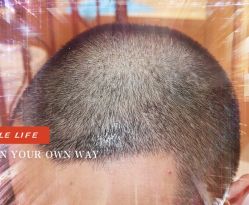 -大麦微针植发全国连锁