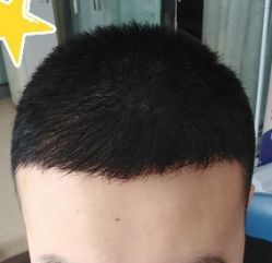 -大麦微针植发丨全国连锁