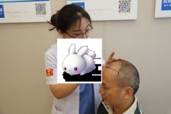 -大麦微针植发丨全国连锁