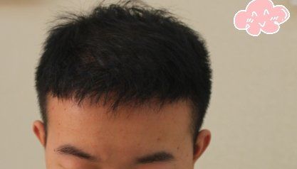 -大麦微针植发丨全国连锁