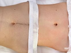 -薇兰专业脱毛连锁机构