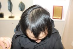 点击看大图 -大麦微针植发丨全国连锁