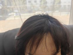 -碧莲盛·不剃发植发