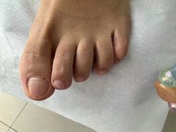 -德哥灰指甲脚气甲沟炎跖疣护理