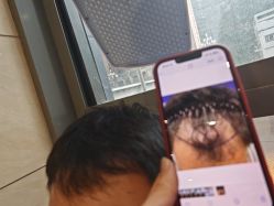 -碧莲盛·不剃发植发