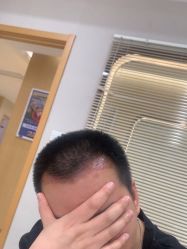 -大麦微针植发丨全国连锁