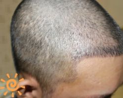 -大麦微针植发丨全国连锁