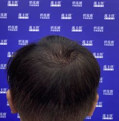 -碧莲盛·不剃发植发