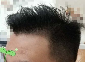 -大麦微针植发丨全国连锁