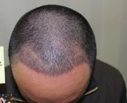 -大麦微针植发丨全国连锁