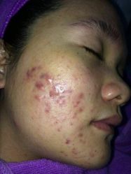 -蕾特恩专业祛痘