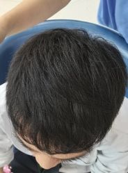 -大麦微针植发丨全国连锁